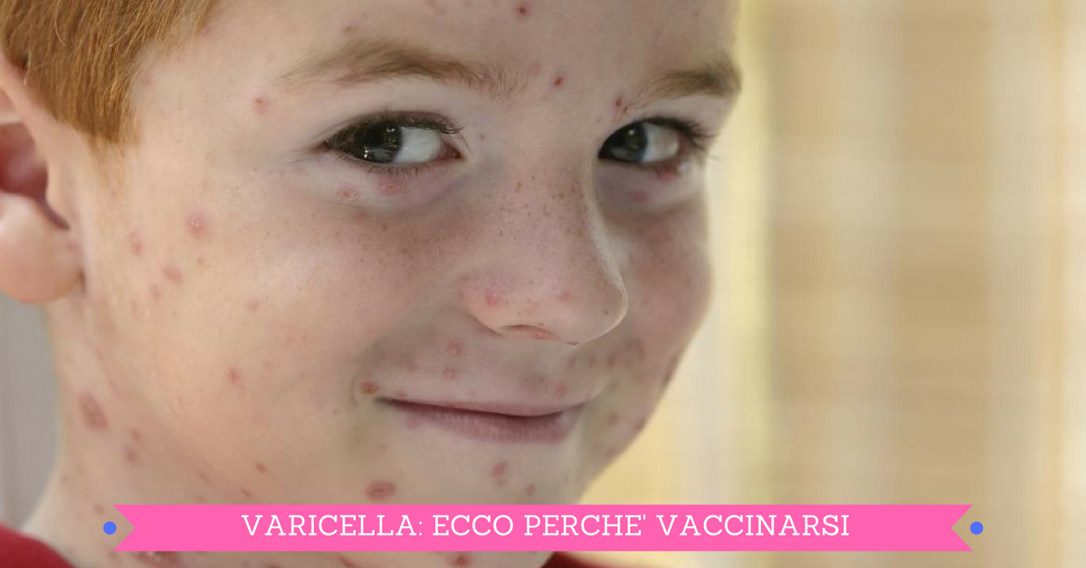 Vaccino per la varicella, ecco perché serve farlo